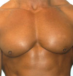 Gynecomasty