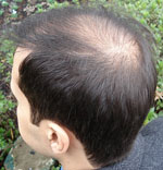 Trasplante de cabello